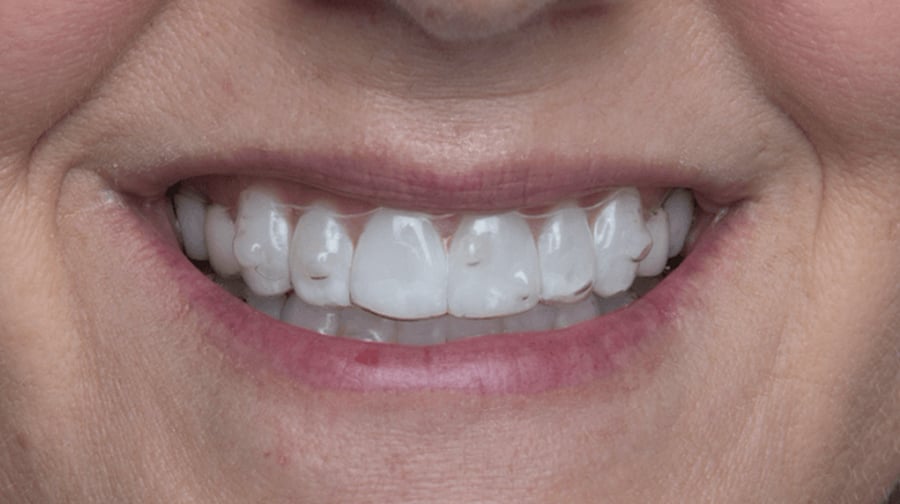 What are the benefits of Spark Aligners?